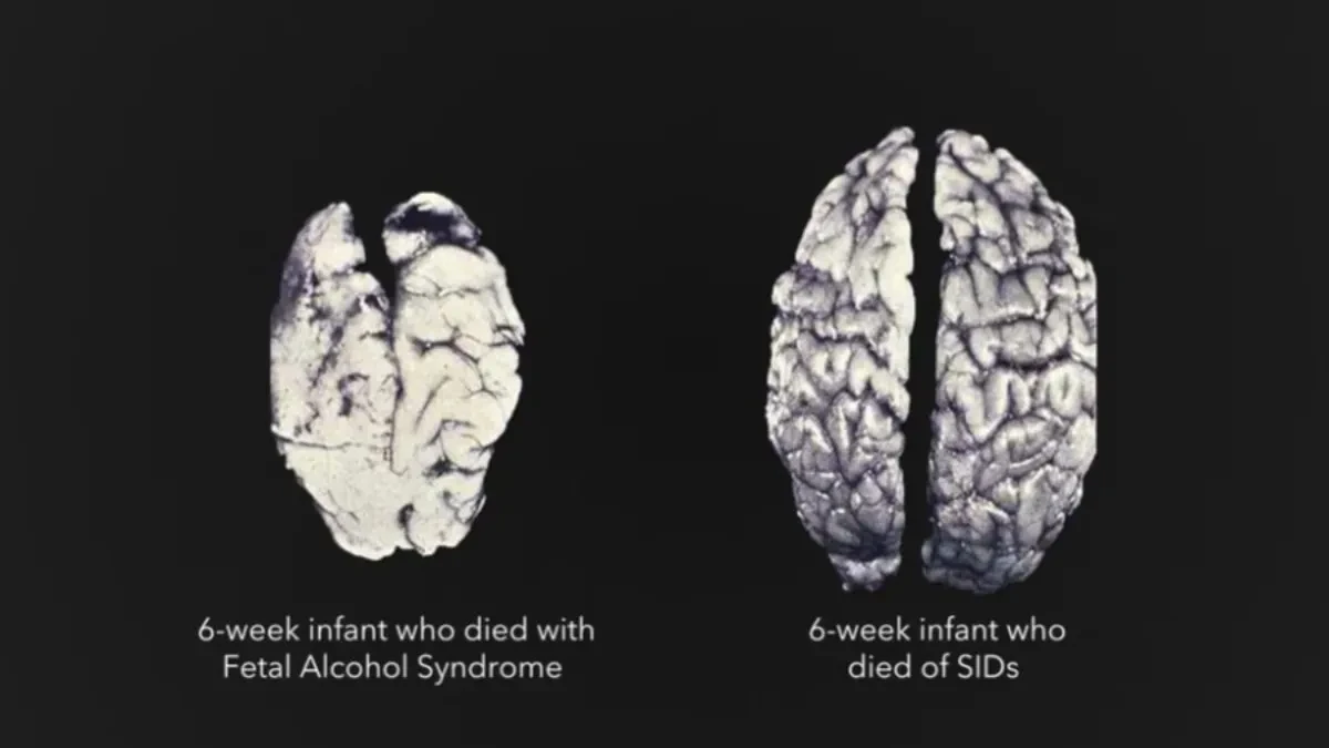 MRI snimci otkrili šta alkohol radi bebinom mozgu još u stomaku: Posledice mogu trajati ceo život