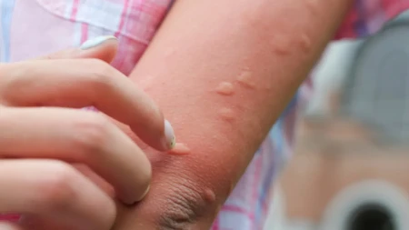 Jedna kašika ovoga može da umanji svrab od ujeda komaraca: Prirodni trik koji mnogi koriste tokom leta