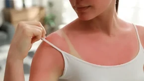 Užasno sam izgorela na suncu: Komšinica mi je dala recept i sutradan sam bila kao nova!