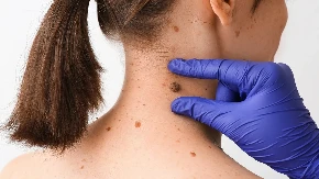 Mladež menja boju, krvari ili svrbi? Doktorka upozorava: Ovo su znaci da odmah morate kod dermatologa