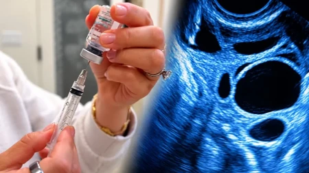 Koliko jajnih ćelija treba zamrznuti za jednu bebu? Doktorka otkrila brojke koje se drastično menjaju sa godinama