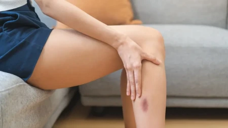 Modrica se pojavila bez udarca – kada može ukazivati na trombozu